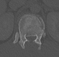 Burst Fracture Axial CT